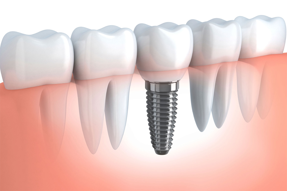 Single dental implant with crown illustration