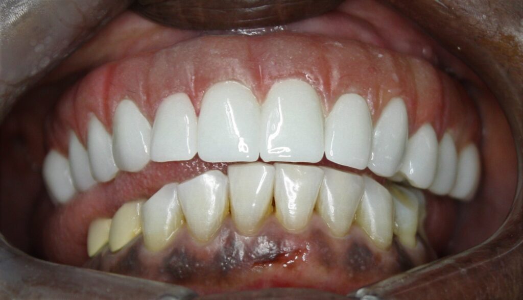 Implant patient - full-mouth result at ImplantArt Tijuana