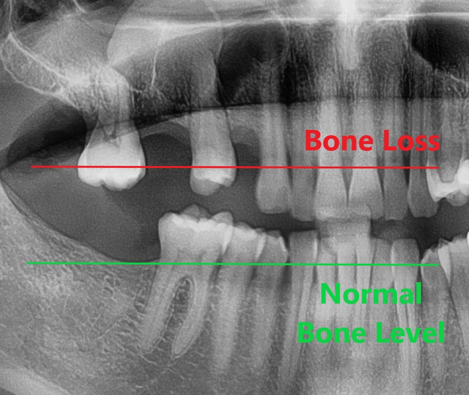Panoramic dental X-ray showing bone loss