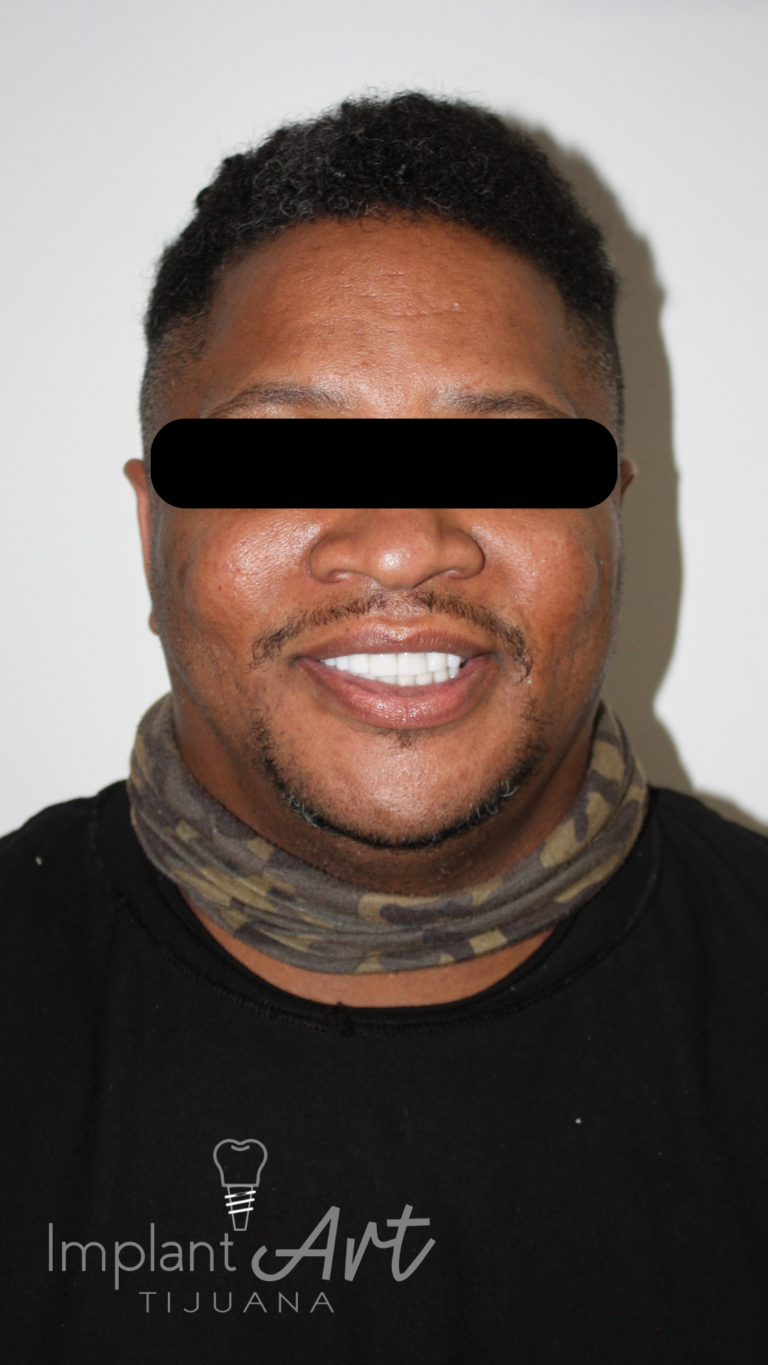Patient smile after zirconia crowns and root canals