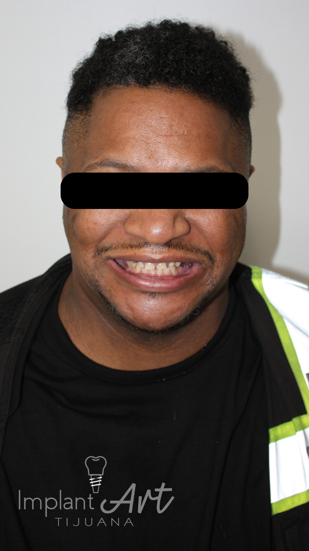 Patient with worn and missing teeth before full smile restoration