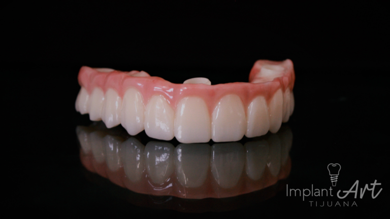 Full-arch implant bridge for an All-on-4 patient case