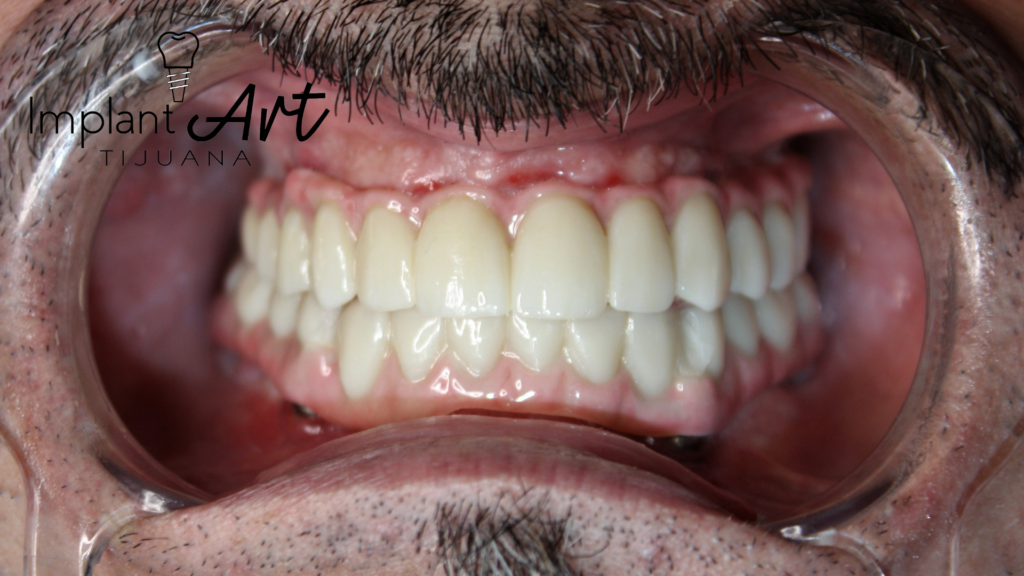 All-on-4 case - new smile at ImplantArt Tijuana