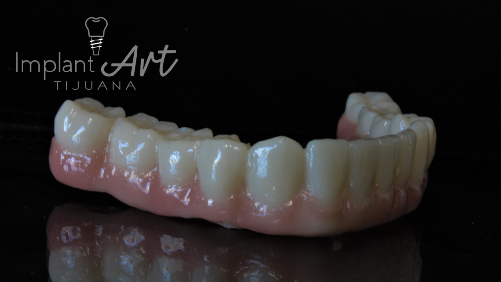 Zirconia full-arch bridge made in the ImplantArt dental lab