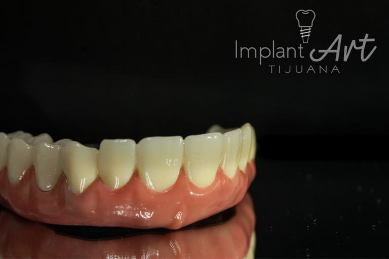 Zirconia bridge on a lab model before delivery