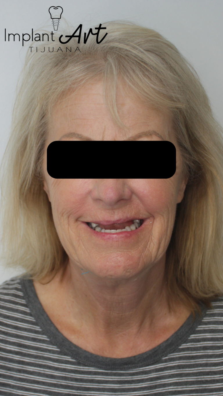Patient before a 7-unit zirconia implant bridge