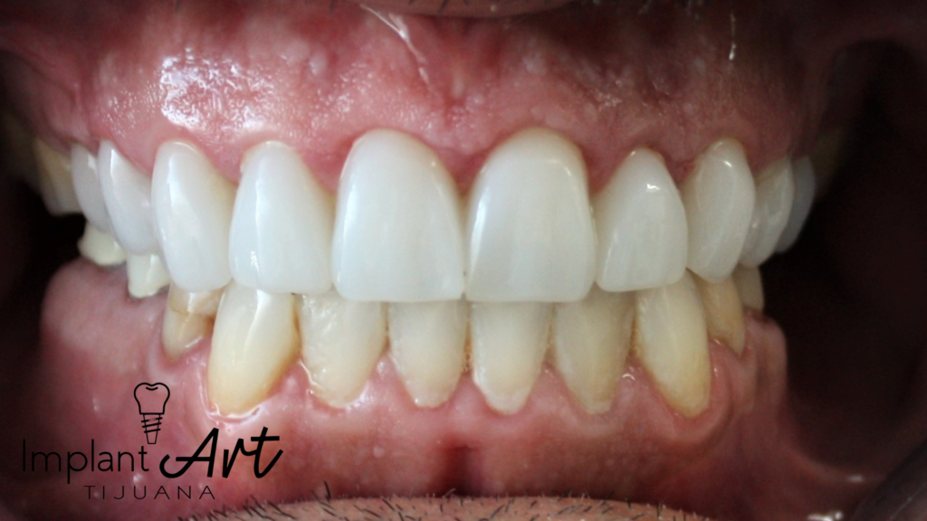 Natural-looking full-arch restoration after All-on-4 treatment in Tijuana