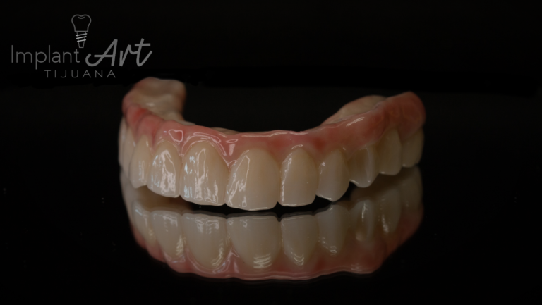 Upper full-arch implant prosthesis with pink gingiva