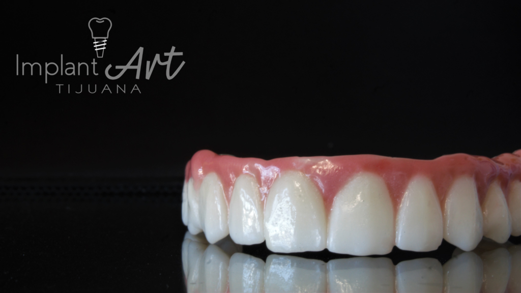 Full-arch implant restoration at ImplantArt Tijuana