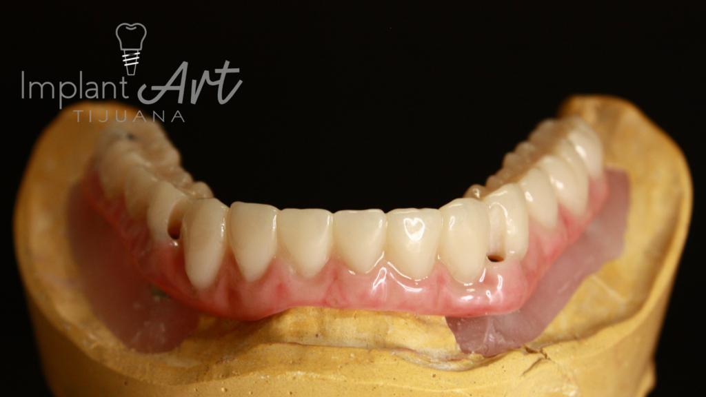 All-on-4 case - lower arch at ImplantArt Tijuana