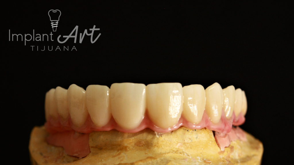 All-on-4 case - upper arch at ImplantArt Tijuana
