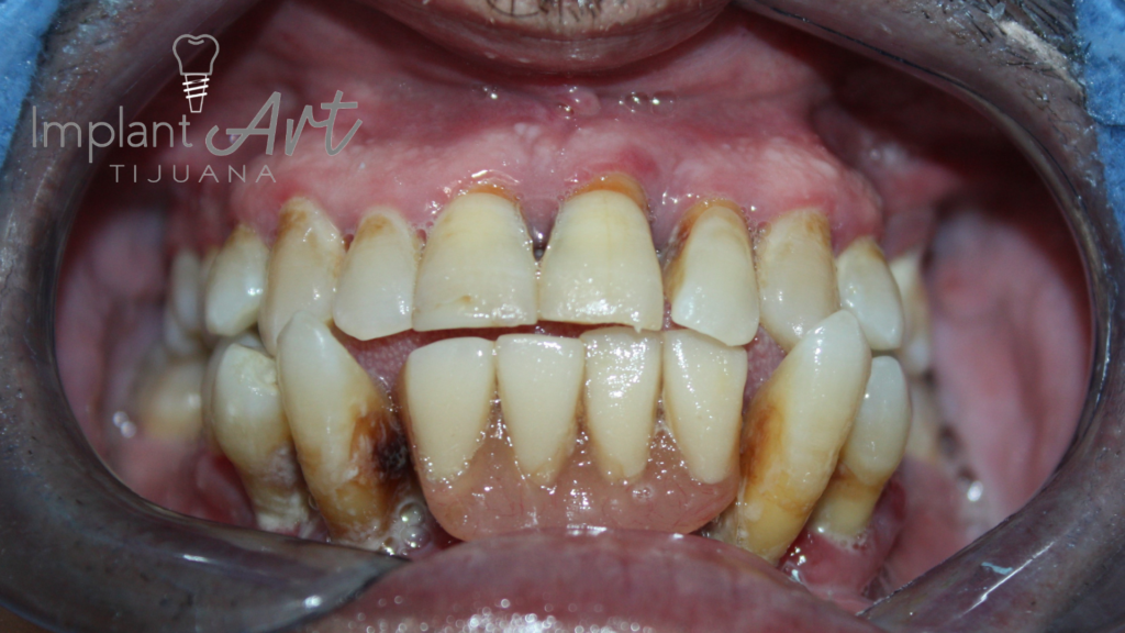 All-on-4 case - full-arch bridge at ImplantArt Tijuana