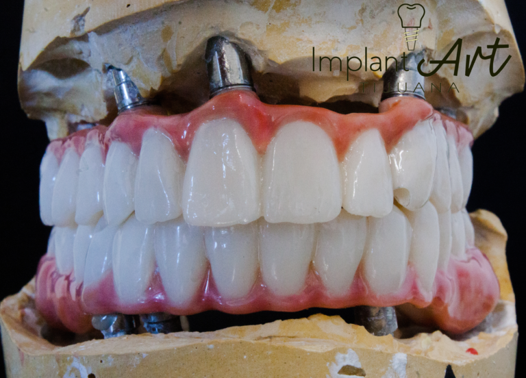 Upper and lower All-on-4 bridges on implant model